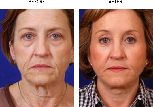 non surgical face lift