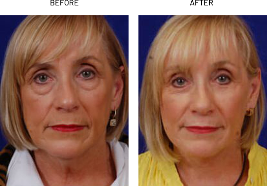 liquid facelift