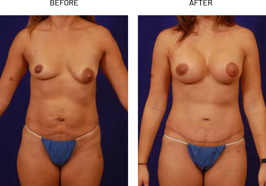 Liposuction patient