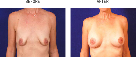 breast lift without surgery