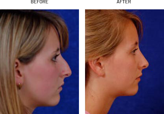 Non-surgical nose job