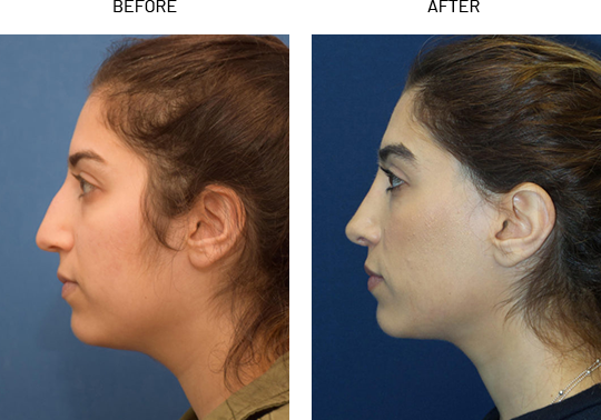 Ethnic rhinoplasty