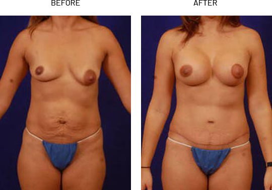 Mini tummy tuck