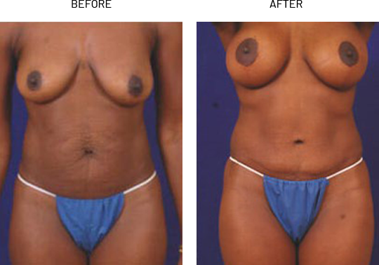 Tummy Tuck