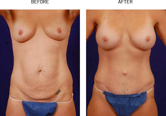 Abdominoplasty patient